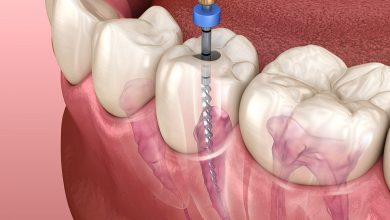 root canal therapy interior