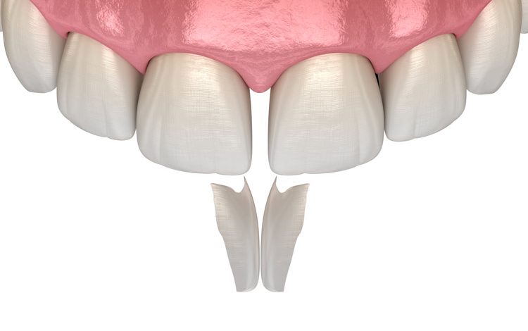 teeth bonding near me