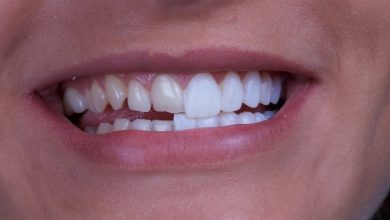 dental bonding gap