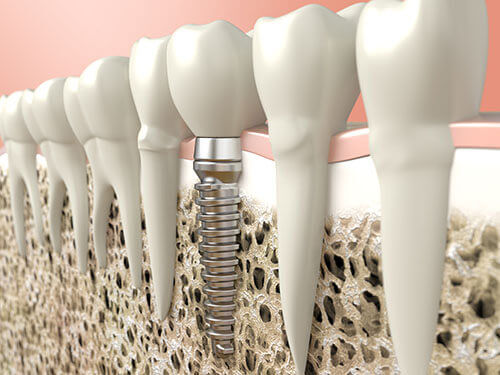 Dental Implants Procedure